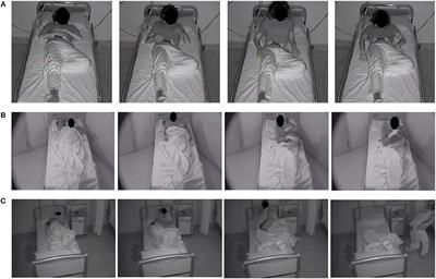 Clinical Features and Pathophysiology of Disorders of Arousal in Adults: A Window Into the Sleeping Brain